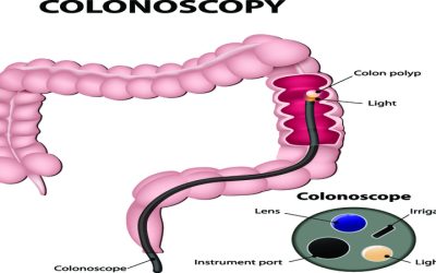 Proactive Measures for Digestive Health: Tackling Colon Cancer in Lima with Modern Care and Prevention