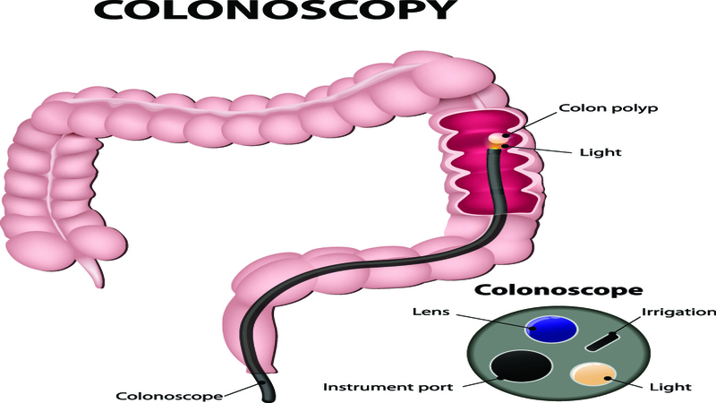 Proactive Measures for Digestive Health: Tackling Colon Cancer in Lima with Modern Care and Prevention