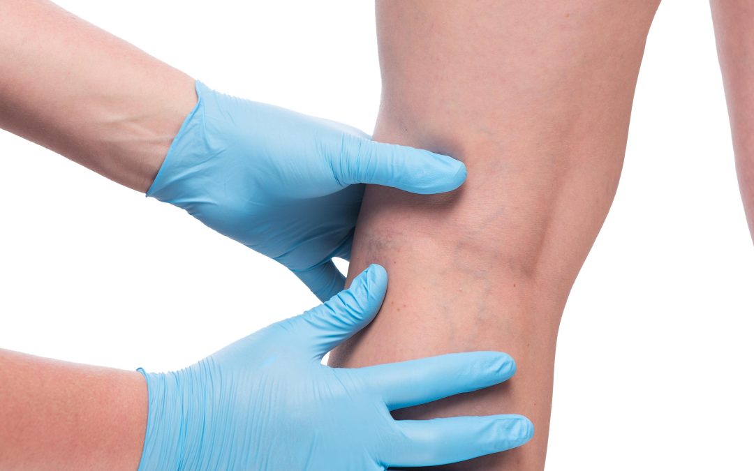 Experience lasting relief from leg pain with a vein specialist in Virginia Beach, VA, today