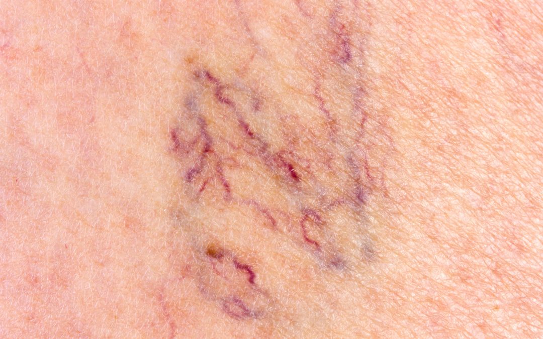 Real Solutions for Leg Pain with Varicose Veins Treatment in Manassas, VA