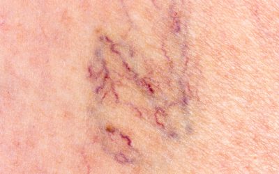 Real Solutions for Leg Pain with Varicose Veins Treatment in Manassas, VA