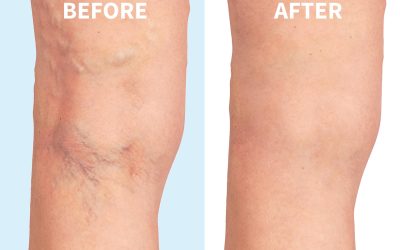 Get Healthier Legs Faster by Visiting a Trusted Vein Specialist in Manassas, VA