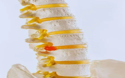 Disc Bulge vs. Herniation: Does Treatment Change (and When Decompression Fits)?